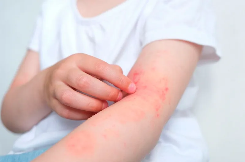 La dermatitis atópica y su importancia en el cuidado de la piel